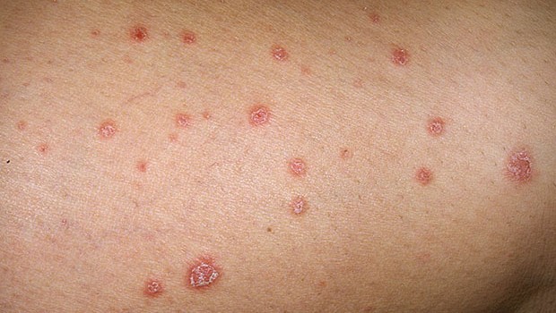El mejor sanatorio por el tratamiento de la psoriasis